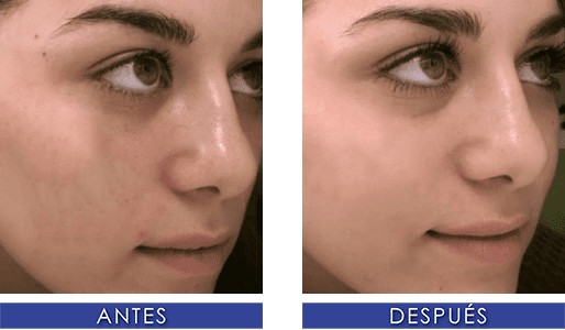Hydrafacial Lima