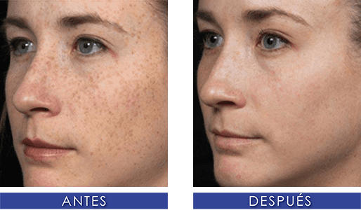 Tratamiento de Manchas