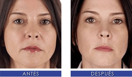 Plasma rico en plaquetas