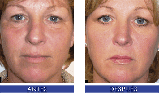 Plama Rico en Plaquetas Lima