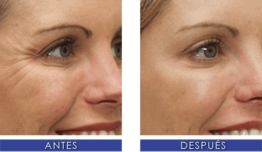 TOXINA-BOTULINICA Toxina Botulinica Lima