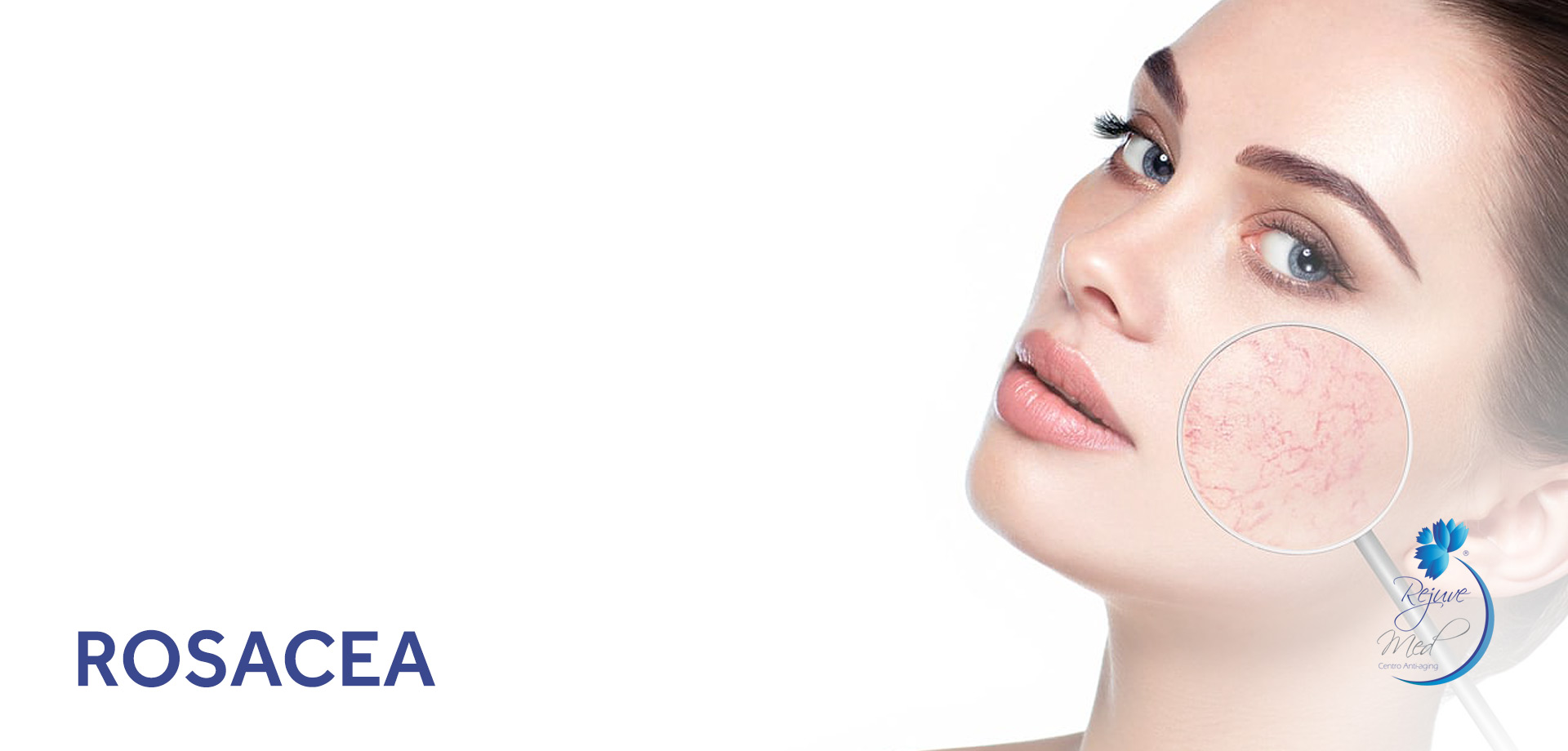 Rosacea Lima