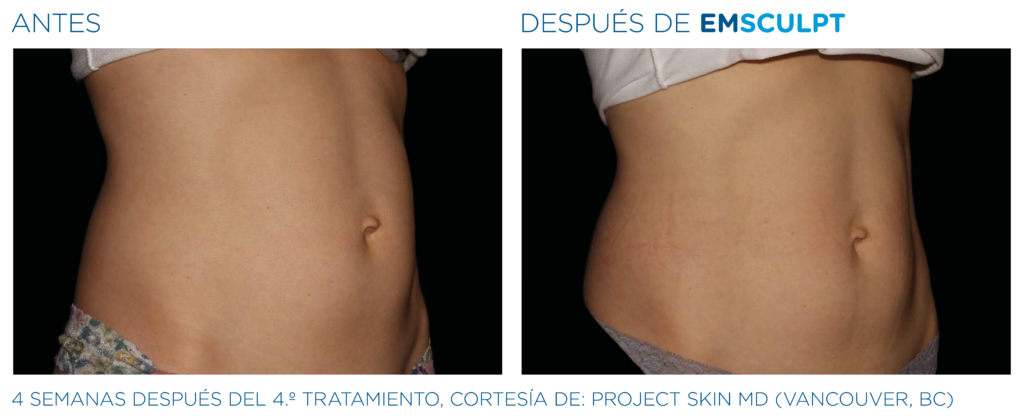 Emsculpt PIC Ba card female abdomen 047 ES100