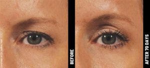 Ultherapy Perú