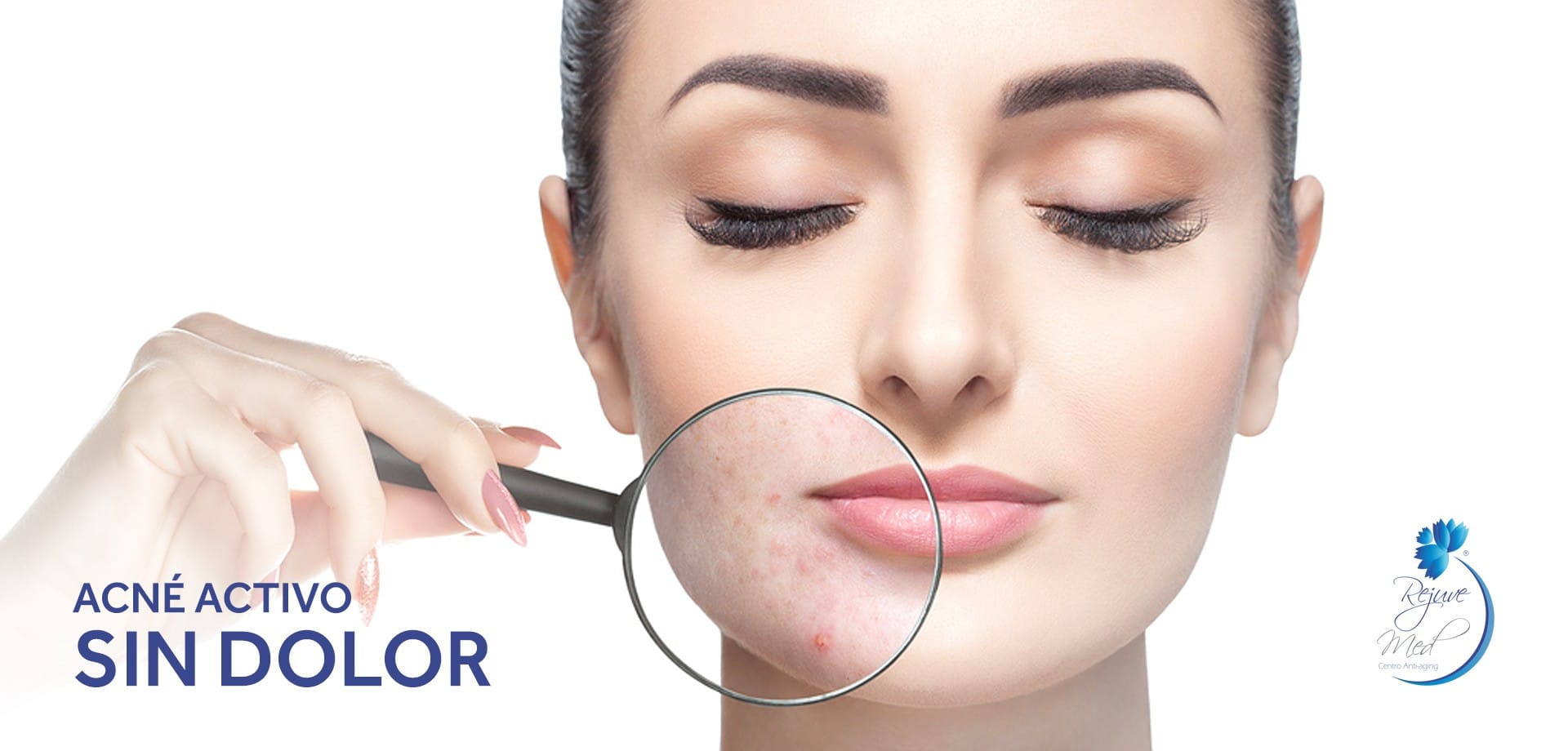 Tratamiento de acné activo con IPL en Lima